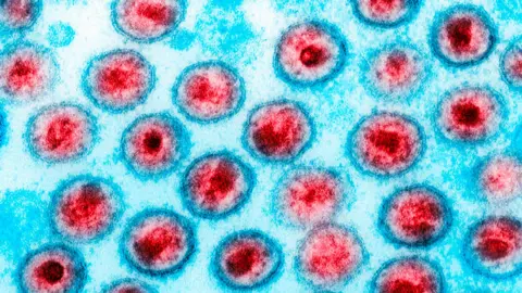 Getty Images A transmission electron micrograph of HIV. 