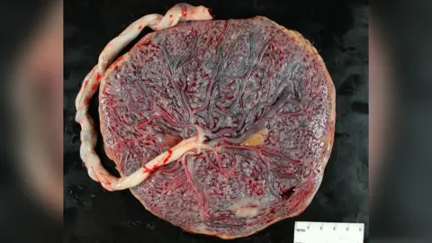 University of Bristol Placenta on a black background