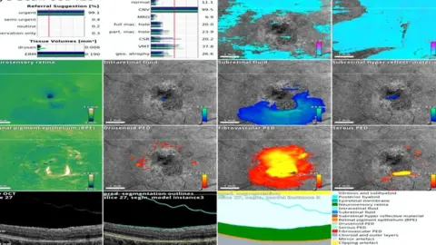 MOORFIELDS EYE HOSPITAL eye scan