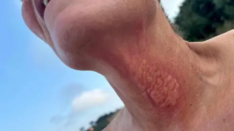 Nikki Cullis Nikki Cullis's neck which has a large jellyfish sting visible