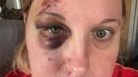 A woman with a black eye and grazed face