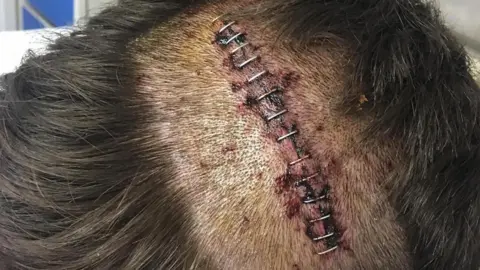 Jack Howitt The top of a scalp with dark hair and an operation scar with stitches.