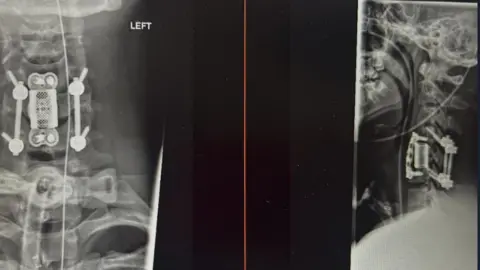 supplied An x-ray showing bones and screws