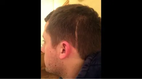 Becki Cobb Simon Commins' head scar from his treatment
