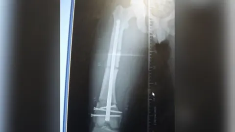 Claire Lewis X-ray of femur surgery