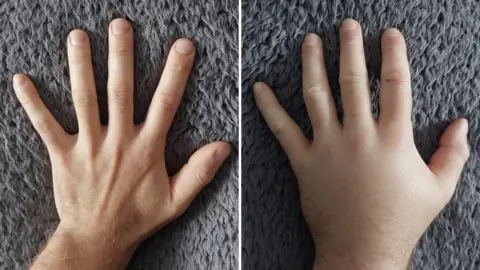Jack Cope Side-by-side comparison of two hands placed palm-down on a grey blanket. The hand on the left appears slimmer and the right appears fuller and puffier.