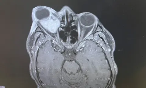 Collect/PA Real Life photo of scan which shows Farid Oladapo's tumour.