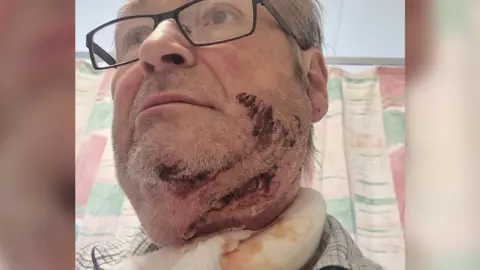 Supplied Chainsaw accident injury on Christopher York in bed in hospital