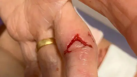 Pat Pope Pat's hand, showing a bite wound on her finger with blood