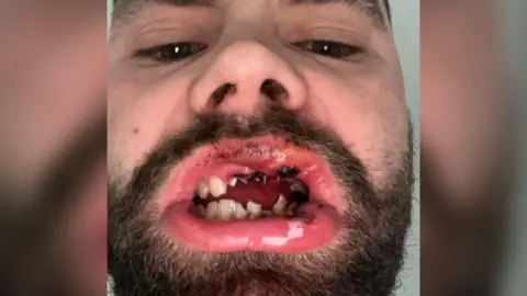 A close up of a bearded man's mouth which has dried blood in it and damaged teeth.