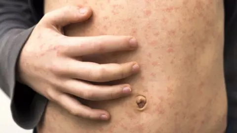 Getty Images Child with measles