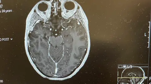 Jesse Tristram One of Jesse's brain scans appears on a black screen detailing the progression of his tumor.