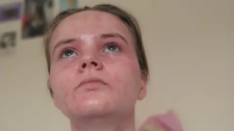 Chloe North Chloe is white with red blotchy skin and her hair is tied up in a ponytail. Her eyes are looking up towards the ceiling