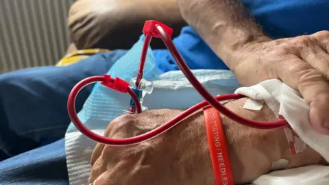 A picture of a man's hand, which is wrapped in red tubes due to dialysis treatment