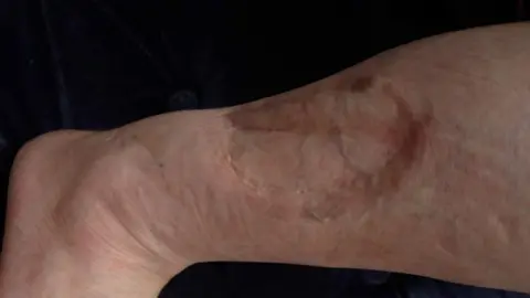 A picture of a scar on Mrs Greenwood's right leg.