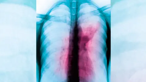 Getty Images Area of the lungs affected by TB