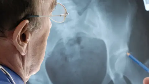 Getty Images doctor examining a hip x-ray