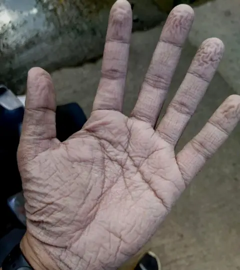 Aseem Gargava Aseem Gargava, a doctor in Mumbai posted this picture of his palm on social media