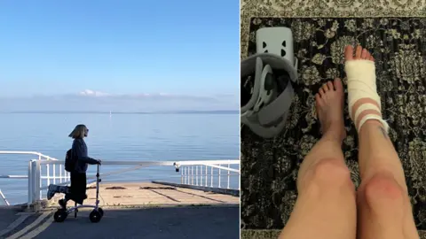 Gina Paletta A few days after surgery, Gina was wearing a boot and travelling by scooter