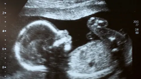 Getty Images Foetal ultrasound scan