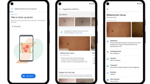 Google Dermatology assist tool image