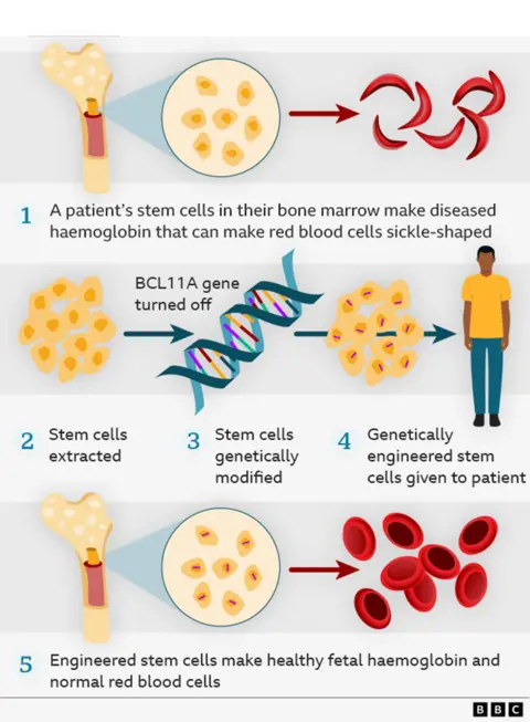 Graphic explaining how the gene therapy works in 5 steps with illustrations. 1) A patient's stem cells in their bone marrow make diseased haemoglobin that can make red blood cells sickle-shaped. 2) Stem cells extracted, and BCL11A gene turned off. 3) Stem cells genetically modified. 4) Genetically engineered stem cells given to patient. 5) Engineered stem cells make healthy fetal haemoglobin and normal red blood cells. 