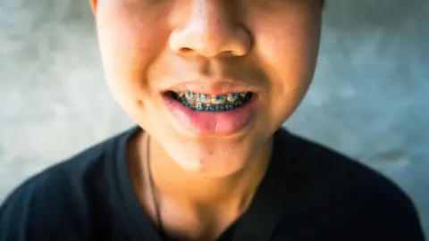 A close-up of a young person's lower face showing metal braces with blue brackets on their teeth. The child is wearing a dark top and their mouth is slightly open to show the dental work. The image is cropped above the nose to protect the child's identity, with a soft grey background behind them.