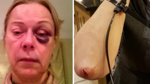 PA Media Injuries suffered by Susan Morris during an attack by the Night Watcher