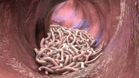 Getty Images A computer generated image of whipworms (Trichuris trichiura) in a human intestine 
