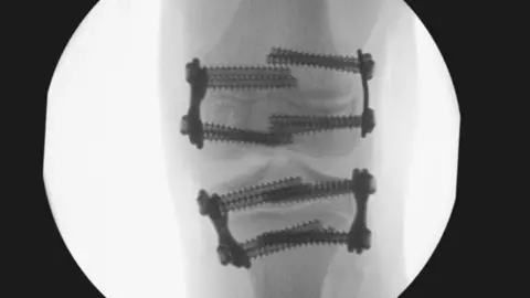 Hudgell Solicitors with permission from Amy's family A black and white x-ray image that shows quad plates fixed above and below Amy's knee joint. The screws are long and overlap in the centre of the picture and the plates are fixed to the outside of the femur and the tibia