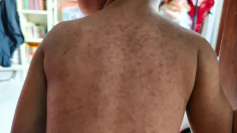 Getty Images A child's back with a rash symptomatic of measles