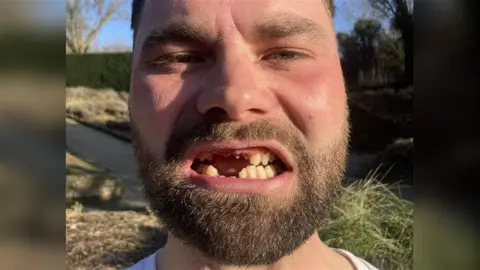 Piers Hopkirk/BBC A man with a brown beard close to the camera showing his damaged teeth.