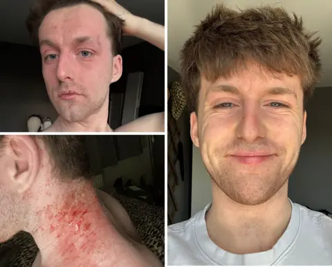 Henry Jones Three pics of Henry Jones at different stages of his TSW journey. Top left image shows him with red, peeling skin on his face. Bottom left image shows his neck sore, red and bleeding. The right image is him now and his skin is clear, he looks healthy and he is smiling.