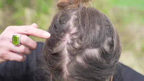 Heather Davey with her head nodded down as she is showing the camera a red scratch, visible through her hair, which she is pointing at.