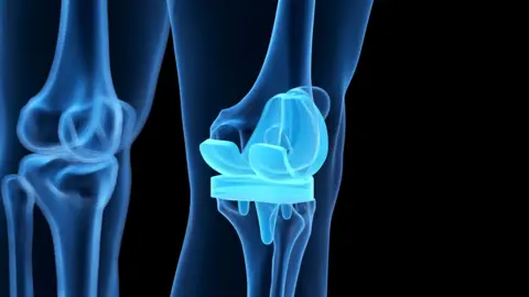 Getty Images Knee replacement joint image