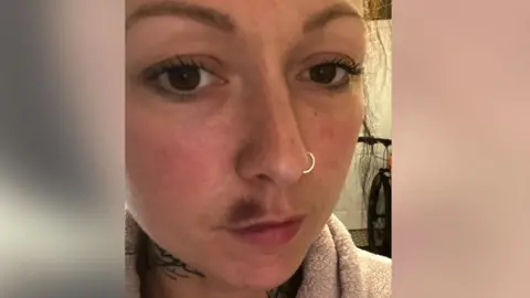 Laura Brooks Picture of a person who had complications after a lip filler procedure