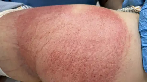 Callum Laird Burns on the leg and rear of Callum Laird, as he lies in a hospital bed