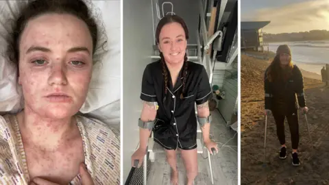 Skye Owen A composite image of Skye during her treatment. On the left there is an image on her lying down in a hospital bed. She has her brown hair tied up. She is covered in a rash. The middle image shows a woman with her hair tied back in braids. She is in black pyjamas and is walking with crutches. One the right is a woman with her hair down, wearing a hat, black coat, leggings and trainers. She is standing on a beach and walking using crutches. 