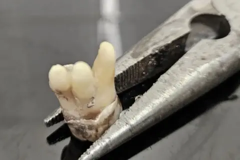 Chris Langston A molar in the grip of a pair of metal pliers