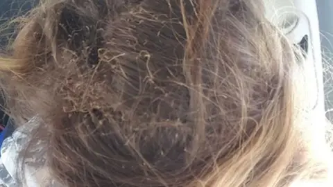 Charlotte Clarke Burns to scalp