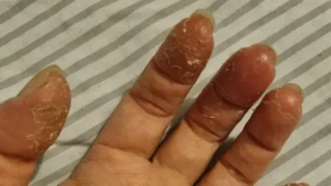 Skin Peeling | Home Remedies to Prevent Skin Peeling on Fingers