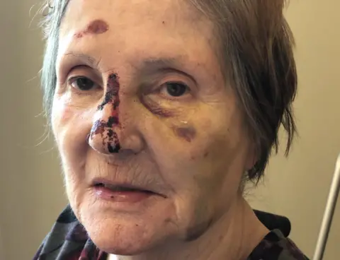 Family photo Sandra pictured with cuts and bruising to the face following a fall