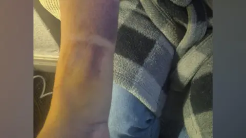 Jenny Rowland A man holds out his right arm showing significant purple and yellow bruising. 