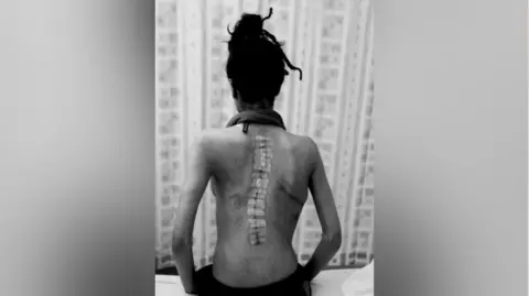 Ayesha Jones A black and white photo shows a woman sitting on a hospital bed, with a stitched down her back. She is wearing trousers and a scarf but no top. The photo is taken from the back and her face is not visible.