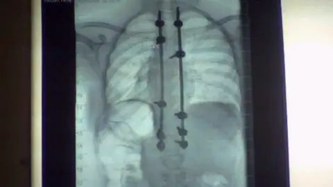IrwinMitchell A scan of Emily Bhogal's spine after her surgery