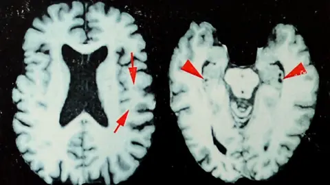 Brain scans of a former NFL player who was diagnosed with CTE