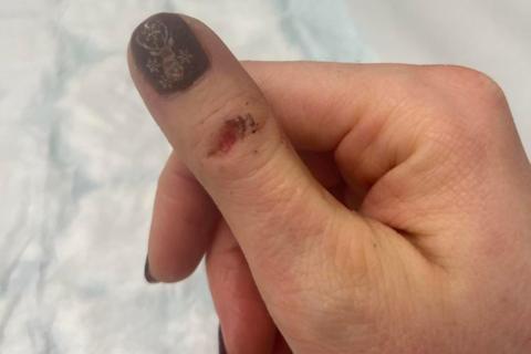 A cut thumb