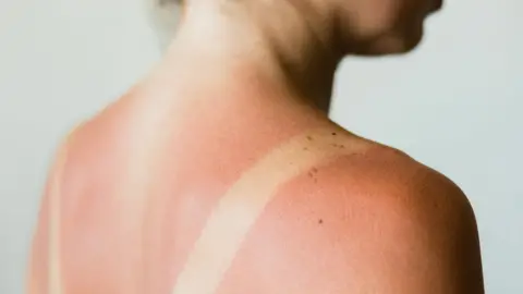 Getty Images Woman with sunburn on her back - stock photo