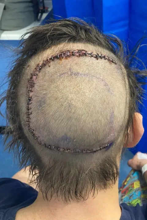 Craig Russell The back of a man's head is on display, it's shaved with a very large and severe scar that covers the majority of his scalp. 