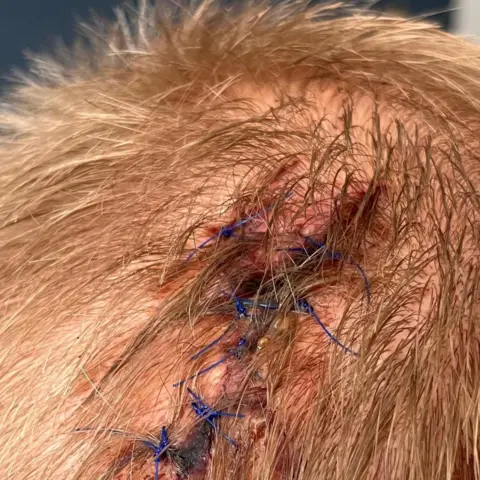 Ross McConnell Stitches to an injury in a man's head.